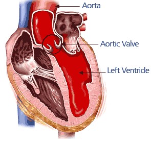 aortic valve map