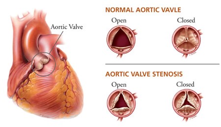 aortic valve stenosis
